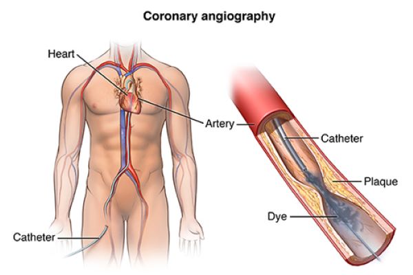 Angiography