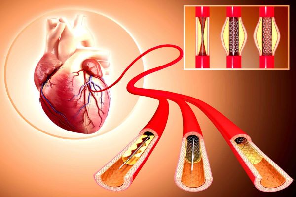 Angioplasty
